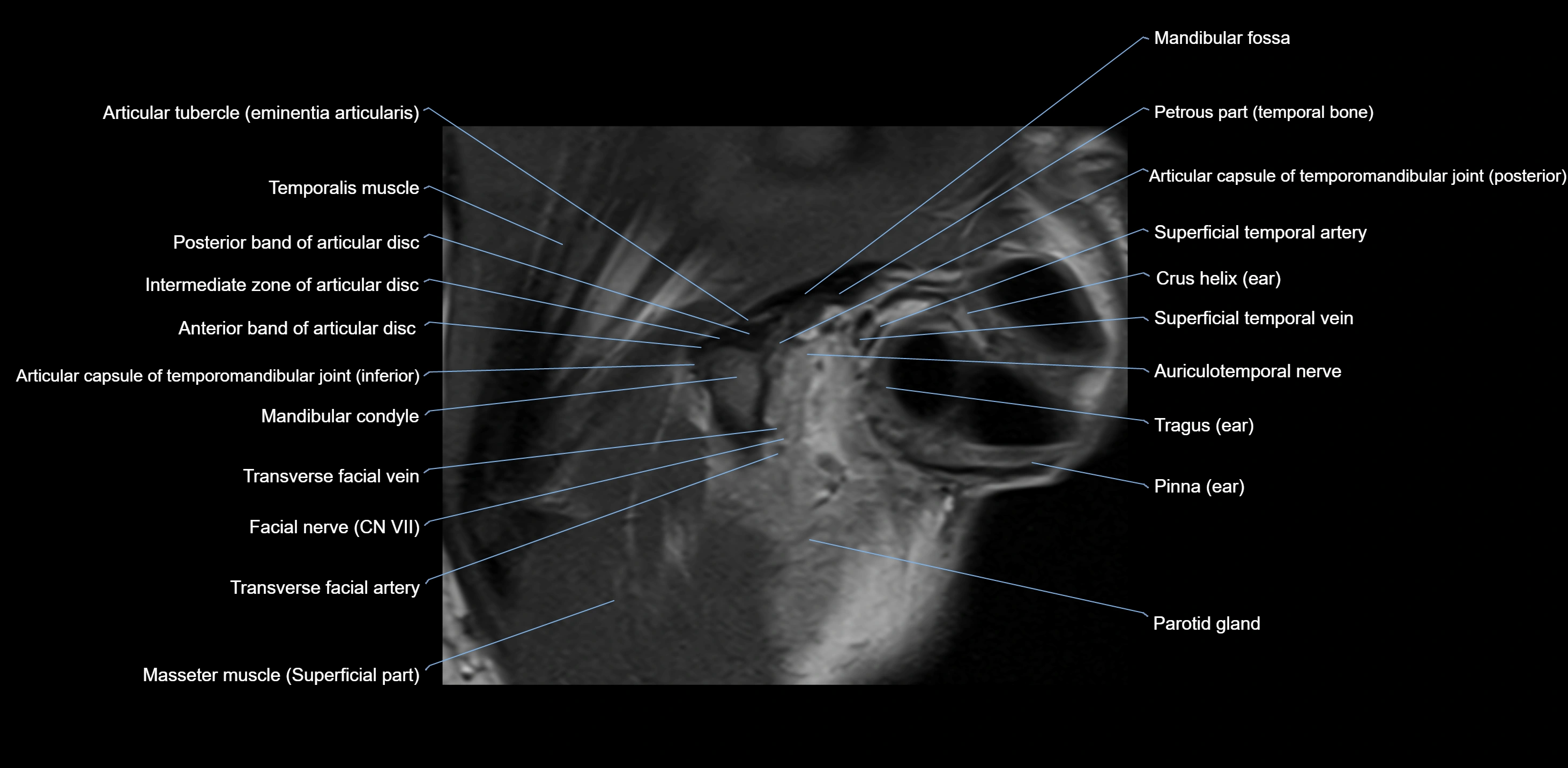 MRI TMJ sagittal open  mouth cross sectional 3T anatomy -img-00001-00004.webp